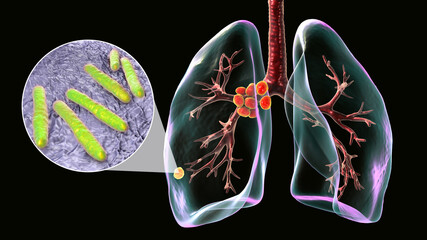 Primary lung tuberculosis, 3D illustration