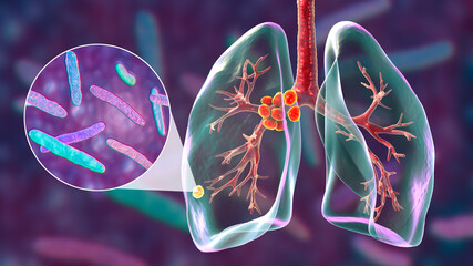 Primary lung tuberculosis, 3D illustration