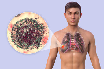 Sticker - Lung cancer, and close-up view of cancer cells, 3D illustration