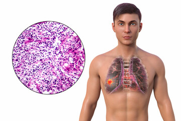 Canvas Print - A man with lung cancer, 3D illustration and micrograph