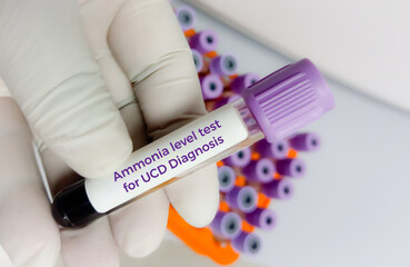 Canvas Print - Ammonia level test for the diagnosis of Urea Cycle Disorder (UCD).