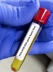 Poster - Pleural fluid for PCR MTB DNA gene Xpert test, to diagnose of TB.