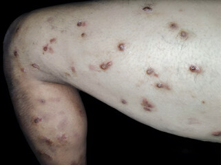 Multiple scattered lesions of varying sizes, some raised and reddish