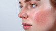 © Oksana - Close up face of young woman suffering from problem skin. Acne, rosacea, dry skin. Dermatology concept