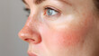 © Oksana - Close up face of young woman suffering from problem skin. Acne, rosacea, dry skin. Dermatology concept