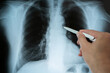 © cunaplus - Doctor radiologically analyzing the chest with x-ray.Hand of a doctor analyzing and pointing with a pen to the affected area