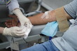 © Vladimir - Almaty, Kazakhstan - 09.10.2024 : The nurse removes the needle with the catheter. The blood center.