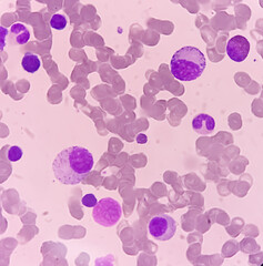 Wall Mural - Active bone marrow normal. Megakaryocyte is normal size and adequate number. Normal active marrow. B cell Lymphoblastic lymphoma patient.