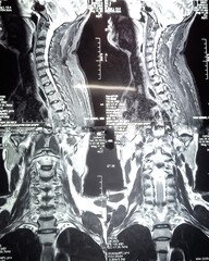 Wall Mural - MRI scan of cervical spine (C-spine) : Nerve root compression and cervical spondylosis, herniation. Medical image concept.