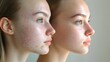 © Alpha - Acne treatment comparison showing a young woman with deep facial acne scars, followed by clear skin in after-treatment shot, natural lighting, detailed focus, bright background
