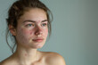 © anzodesign - Natural portrait of a young woman with acne and redness on her face