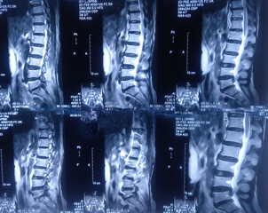 Wall Mural - MRI scan of lambo-sacaral spine (LS-spine) : Central and left paracentral extrusion. Nerve root compression with spinal canal stenosis. Medical image concept.