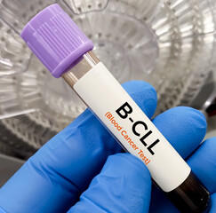 Sticker - Blood sample for Beta cell chronic lymphocytic leukemia (B cell CLL) Chronic Lymphoblastic Leukemia (CLL) blood test. Blood cancer.