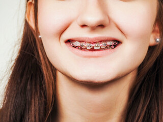 Teenager girl showing her expensive and stylish modern pink color braces. Light background. Selective focus. Dental job on improving appearance. High cost procedure. Health and beauty concept.