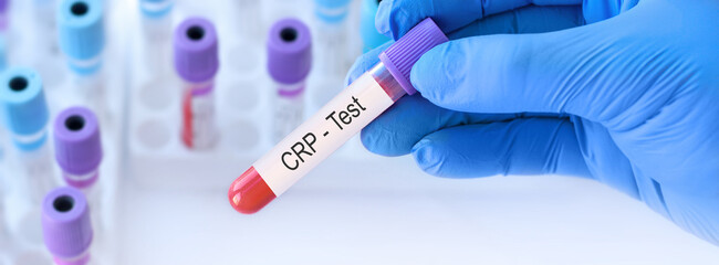 Doctor holding a test blood sample tube with CRP test on the background of medical test tubes with analyzes.