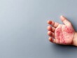 © MP-AI - A child's hand with visible skin condition on a grey background, illustrating dermatological issues.