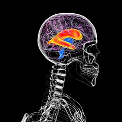 Sticker - Enlarged lateral ventricles of the brain, 3D illustration