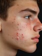 © vefimov - Close-up acne on teenage boy's face.