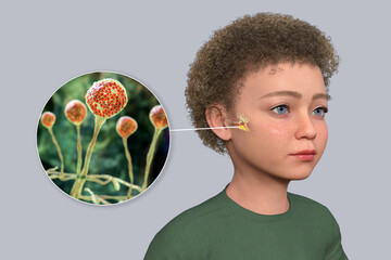 Sticker - Otitis media in a child, 3D illustration