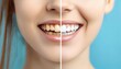 © Wimon - Before and after comparison of a dental implant surgery, showing the transformation of missing teeth to a full, natural-looking smile.