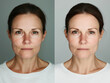 © Rocher Creative - Before and after face treatment, skin improvement.