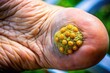 © Danicha - Close-up of a plantar wart on a foot, illustrating a common dermatological condition for education