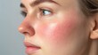 ©  premium content - Close-Up of Woman's Cheek Showing Visible Signs of Rosacea for Healthcare Awareness