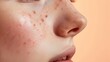 © Exotic Escape - Close-Up of a Face Highlighting a Distinct Acne Spot on Nose
