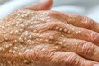© Milan - A close-up image showing a human hand with multiple raised, white bumps and spots covering the skin, indicative of a dermatological condition or skin texture variation.