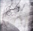 © MdBabul - Coronary angiogram of right coronary artery during cardiac catheterization with dye. Findings abnormal, block are seen.