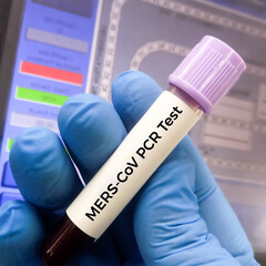 Canvas Print - Blood sample for MERS-CoV (Middle East respiratory syndrome coronavirus) test.