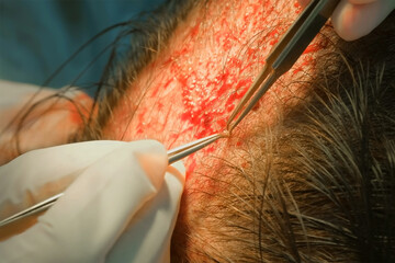 Surgeon making hair transplantation surgery on patient head skin in clinic. Problem of baldness, treatment of alopecia by hair transplanting. Doctor puts hair grafts in scalp holes on operation.