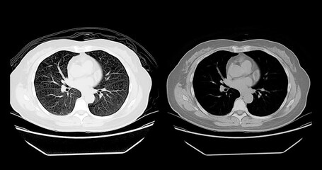 Wall Mural - The CT scan footage shows clear and well-defined lung tissues, indicating a normal case with no signs of abnormalities.