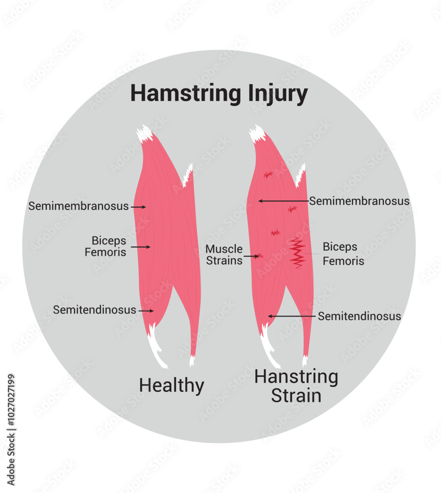 Hamstring Injury Science Design Vector Illustration Diagram Stock ...