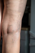 © leroy - A mature woman is taking care of her legs. Back view of knee - Popliteal fossa. Foot care. Venous disease - varicose veins.