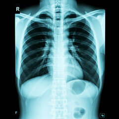 X-ray image of a human chest, showing the ribcage and lungs, similar to the first image, typically used for medical purposes