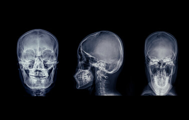 Poster - X-ray image of the skull in series view, displaying clear bone structure with no visible abnormalities.