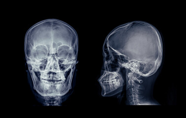 Poster - X-ray image of the skull in AP (anterior-posterior) view, displaying clear bone structure with no visible abnormalities.