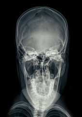 Poster - X-ray image of the skull in town's view, displaying clear bone structure with no visible abnormalities.