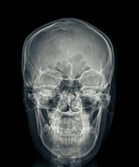Poster - X-ray image of the skull in AP (anterior-posterior) view, displaying clear bone structure with no visible abnormalities.