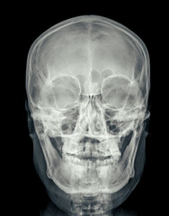 Poster - X-ray image of the skull in AP (anterior-posterior) view, displaying clear bone structure with no visible abnormalities.