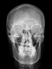 Poster - X-ray image of the skull in AP (anterior-posterior) view, displaying clear bone structure with no visible abnormalities.