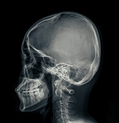Poster - X-ray image of the skull in AP (anterior-posterior) view, displaying clear bone structure with no visible abnormalities.