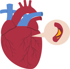 Heart disease illustration. Cardiovascular disease illustration.