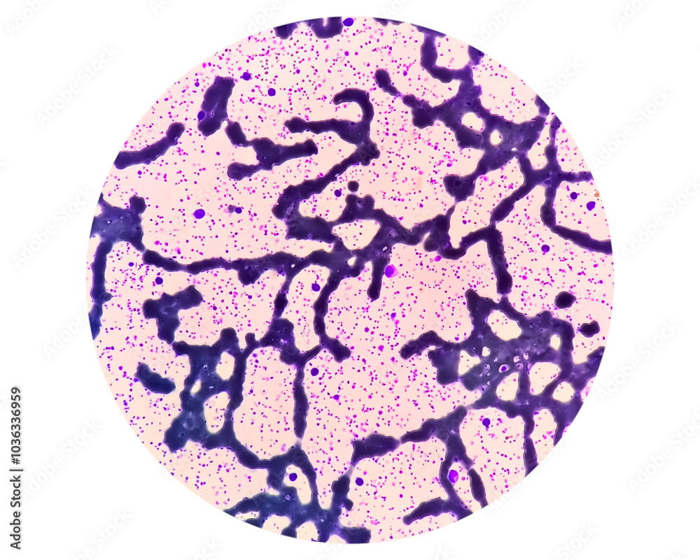 Thrombocytosis blood smear, present abnormal high platelet count ...