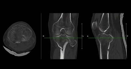 Poster - knee joint ct-scan revealing tibial fracture:the scan highlights a distinct fracture in the tibia, l