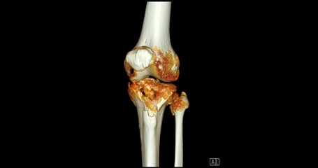 Poster - knee joint ct-scan revealing tibial fracture:the scan highlights a distinct fracture in the tibia, l