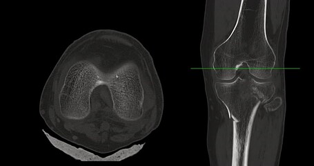 Poster - knee joint ct-scan revealing tibial fracture:the scan highlights a distinct fracture in the tibia, l