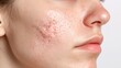 © ImagineWorld - Close-Up of Facial Skin with Acne and Scarring Highlighting Common Skin Conditions and Texture