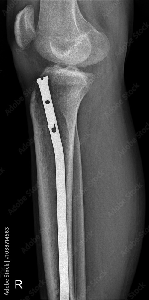 Lower limb radiograph showing tibial IM nail surgery Stock Photo ...